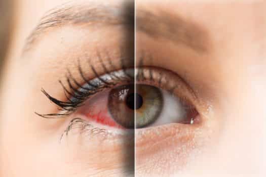 gros plan sur un oeil irrité pour illustrer la formation continue opticien ICO CMO sur les conséquences visuelles des principales pathologies oculaires